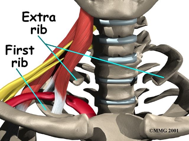 What Causes Thoracic Outlet Syndrome and How to Treat It